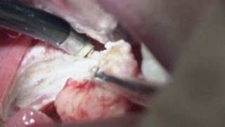 Tonsillectomy (Tonsil Surgery)