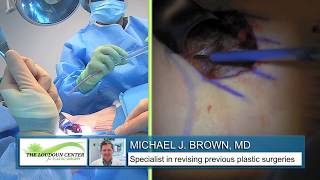 Breast Augmentation Surgery: Michael J. Brown, MD Live Stream