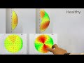 What is keratoconus?