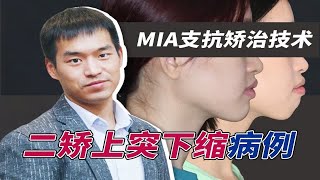 二矫上突下缩病例一枚，MIA技术，用骨钉让下颌后缩的你体验正畸送下巴