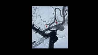 Dissecting ACA Aneurysm