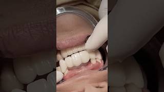 Zirconia bridge to replace missing teeth #satisfying