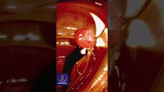 Colon Polyp Removal - 3D Animation