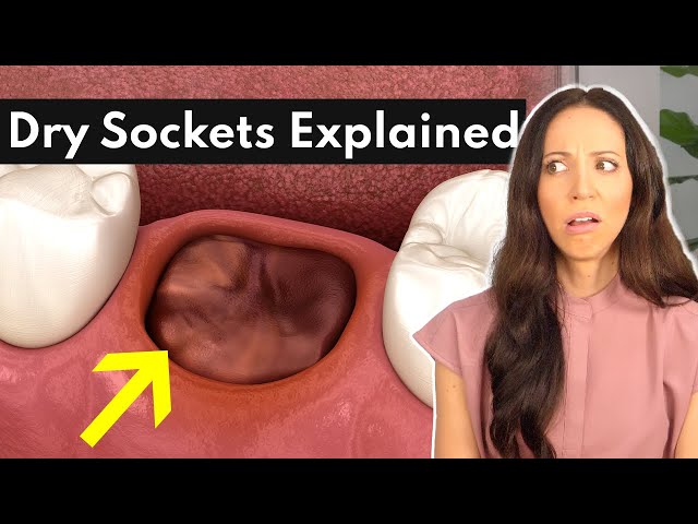 Dry Socket Vs Blood Clot