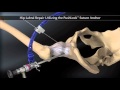 Hip Labral Repair Utilizing the PushLock - Suture Anchor (C)