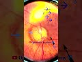 smartphone fundus videography fundus photography myopic crescent tesselations short video 43