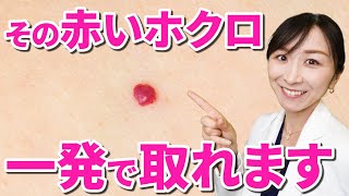 【赤いホクロ】それ、簡単に取れます。皮膚科医が解説