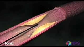 Stents for blocked arteries versus medication and lifestyle changes