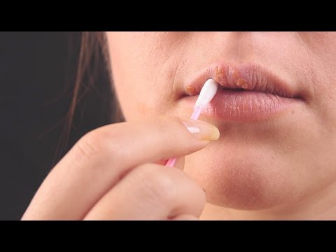 5 ways to get rid of a cold sore overnight 5 ways to get rid of a cold sore overnight