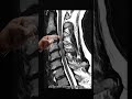 cervical spondylosis mri analysis shorts