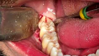 horizontal wisdom tooth extraction