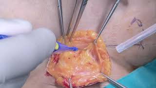 Inguinofemoral lymphadenectomy, radical dissection, 2021, Ilker SELCUK