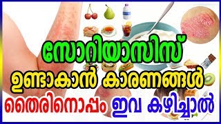 സോറിയാസിസ് ഉണ്ടാകാൻ കാരണം തൈരിനൊപ്പം ഇവ കഴിച്ചാല്‍ | These are the reasons for Psoriasis