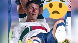 Ronaldo's Collision with Czech Republic's Goalkeeper left him bleeding heavily 😢