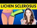 Lichen Sclerosus: WHY YOU HAVE IT & HOW TO TREAT IT