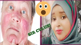 GUDGUDUDKA AMA DHIIGRORKA WAJIGA QAABKE LOO DARYEELA? || TIPS FOR SENSATIVE SKIN😱