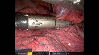 Uniportal Robotic Wedge Resection (uRATS)