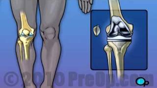 Knee Replacement PreOp® Patient Education