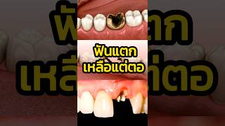 ฟันแตก เหลือแต่ตอทำไงดี #ฟันแตก #ยิ้มพิมพ์ใจ #ฟันปลอม  #ทันตกรรมครบวงจร  #ถอนฟัน #รากเทียม