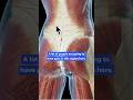 Is it SI Joint Pain or Back Pain?