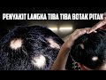 RAMBUT BOTAK. Lain dari yang lain. PENYEBABNYA APA YA ?