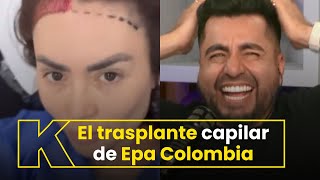 Epa Colombia mostró los detalles del trasplante capilar que se realizó