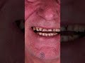 reddick’s stunning smile transformation at cayra clinic antalya