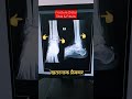 Ankle का भयानक Fracture😲 | Fracture Distal Tibia Fibula #xray #radiography #shorts