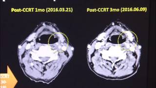 Radiation Surgery