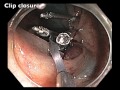 IC Valve Flat Lesion EMR   clip