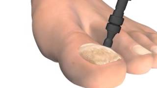 How Does Laser Toenail Fungus Removal Work?