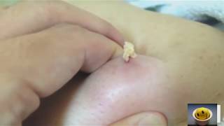 Pimples Popping Compilation: Flying Pimples, Huge Nasty Cysts