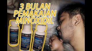 PROGRES DARI HARI 1- 3 BULAN PEMAKAIAN MINOXIDIL + BIOTIN TANPA GEN