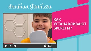 😬 Процесс установки брекетов в Дентал Фэнтези