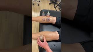 Cupping for calf tightness #cupping #physicaltherapy