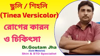 ছুলি বা  শিহলি রোগের কারণ ও চিকিৎসা (Causes and treatment of Pityriasis Versicolor)