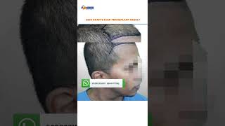 2200 Grafts Hair Transplant #shorts  #youtubeshorts  #hairtransformation