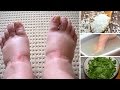 Home Remedies for Swollen Feet Home Remedies for Swollen Feet