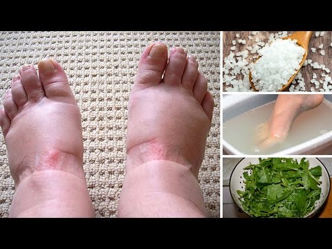 Home Remedies for Swollen Feet Home Remedies for Swollen Feet