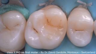 Class II MO on First Molar using myClip 2.0 - Dr. Gerdolle