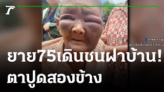 ยาย 75 เดินชนฝาบ้าน ตาปูดสองข้าง | 24-07-65 | ไทยรัฐนิวส์โชว์