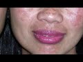 hyperpigmentation causes u0026 best treatments dark spots का इलाज by dermatologist dr. sanjay singh