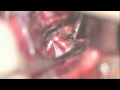 Case2voCO2 Laser for Cavernous Malformation Resections: Video 4