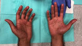 Botox palm injections for hand sweating (hyperhidrosis)