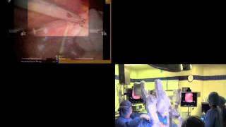 DDW 2014 Presentation: 'Robotic Liver Resection Segments V, VI, \u0026 VII'