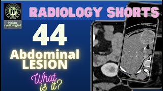 RADIOLOGYSHORTS 44 || ABDOMINAL LESION _WHAT IS IT? || NOBAKBAK VIDEOS