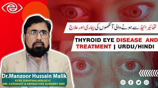 Thyroid Eye Disease And Treatment | Urdu/Hindi
