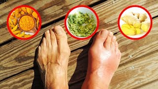 A Doctor Explains The Causes Of Gout And How To Treat It Right