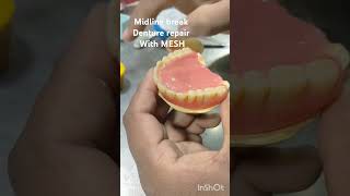 Midline break dentures repair with mesh