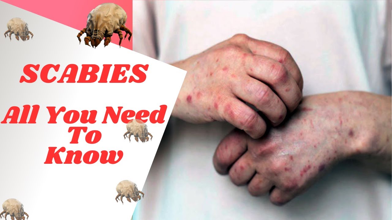 How To Identify & Treat Scabies: Causes, Symptoms, And Prevention - YouTube